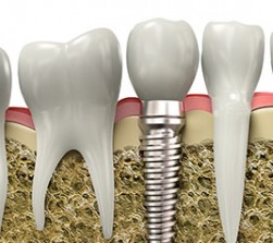 Bild Zahnarzt Berlin - Implantatversorgung